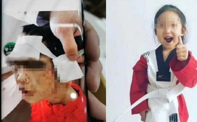 黑龙江4岁女童被继母虐打曝光。