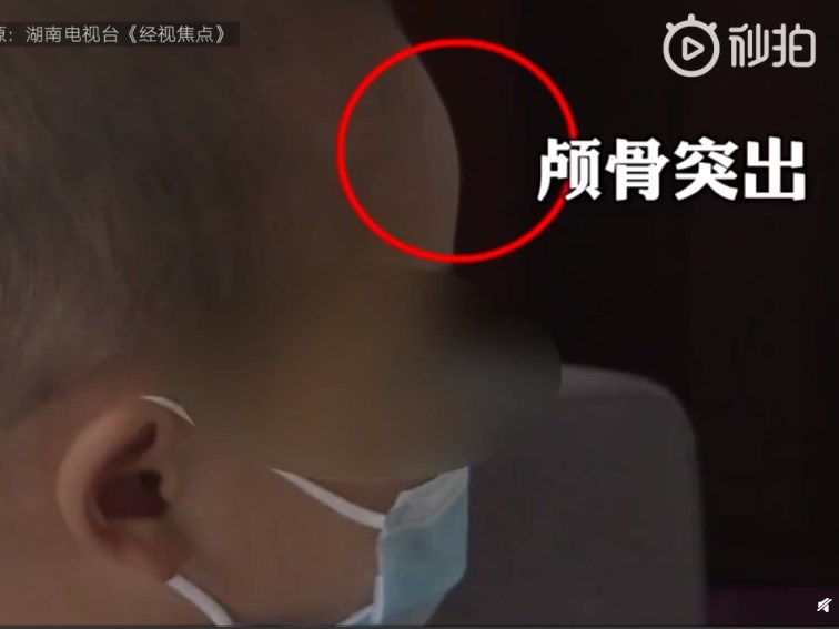 小孩畸形的大頭娃娃（圖取自新京報微博weibo.com）