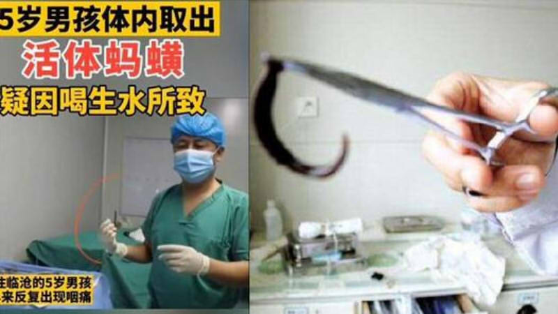 5岁男孩气管内取出6厘米长蚂蝗