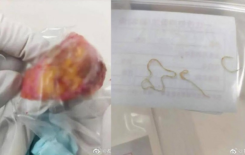 食用生冷食物要小心 杭州女体内剖出近10条寄生虫