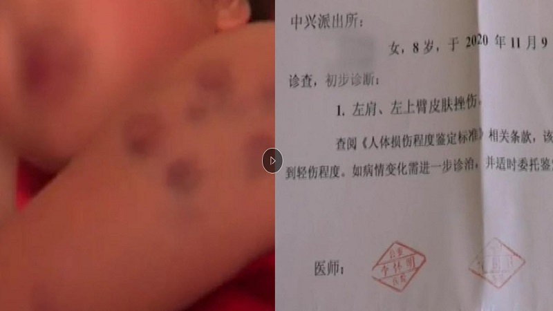 8岁女孩被老师殴打多处受伤 警察称这是法律漏洞不能管