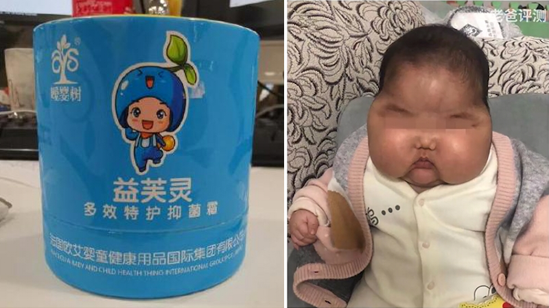 婴儿使用抑菌霜两个月成大头娃娃