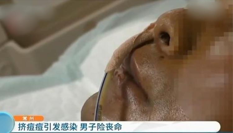 男子挤痘痘引发双肺感染住进ICU