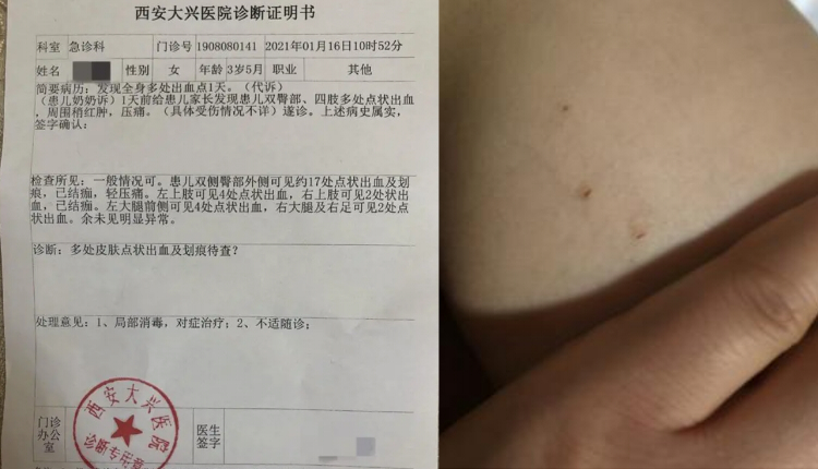 西安3岁女童身上现29处针眼