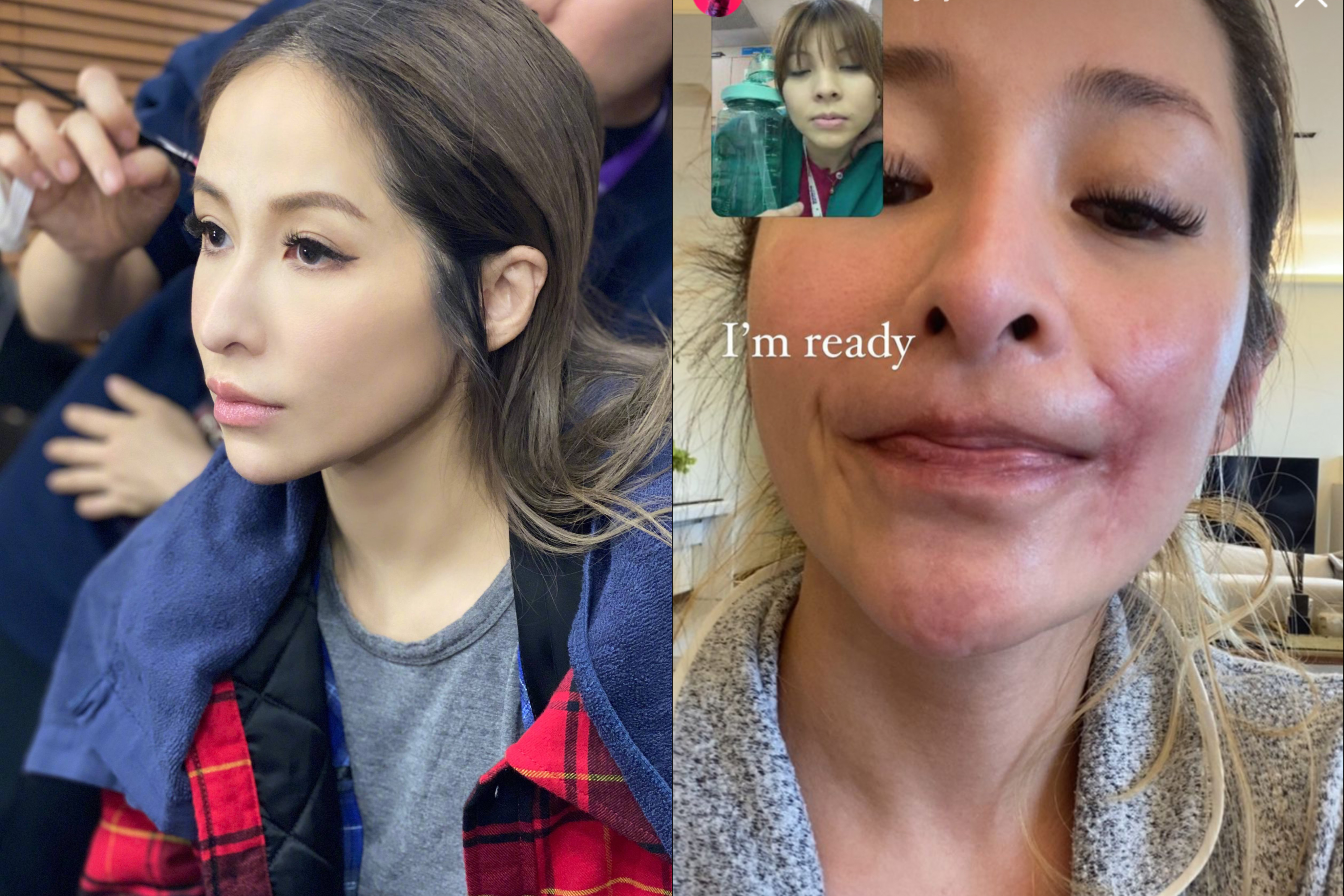 萧亚轩被狗咬伤疤痕照