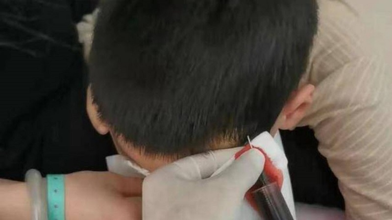 心狠手辣 河南教师将男孩的头皮与头骨扯分离