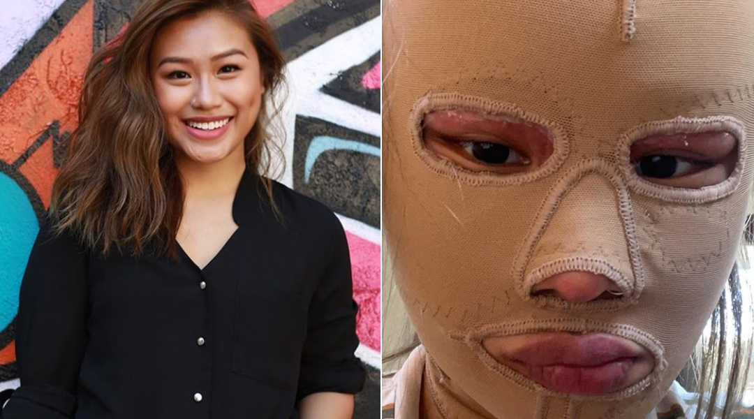 Charlene Chew毁容