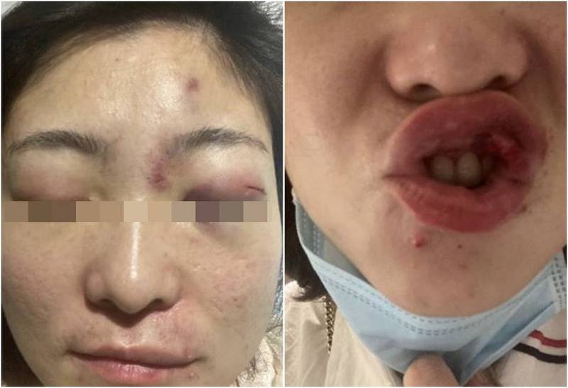 女子提供自己當晚過後臉上的傷勢照