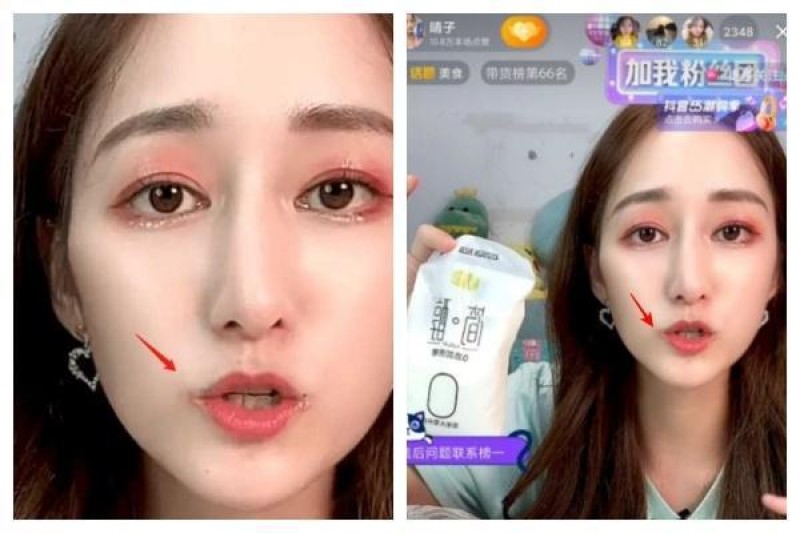 知名吃播网红“吃不饱的晴子”近日被发现嘴角明显溃烂且牙齿发黑。 （翻摄自微博）