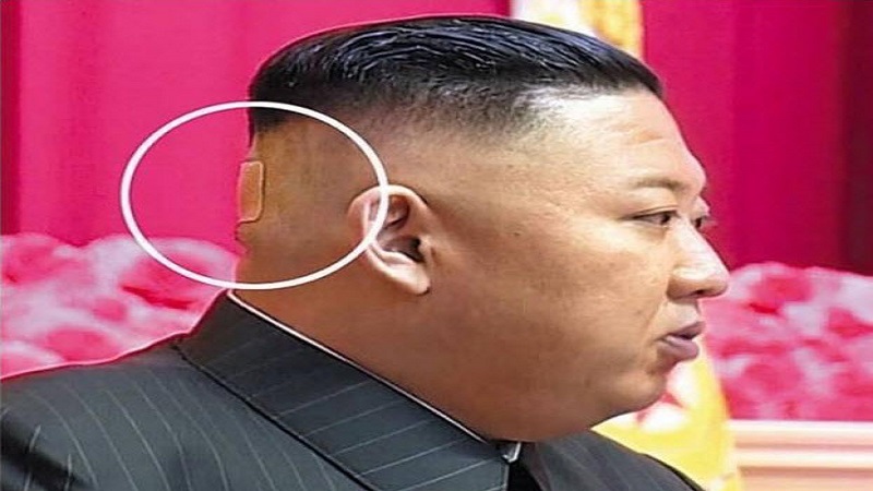 健康亮红灯？金正恩后脑勺惊现神秘胶带