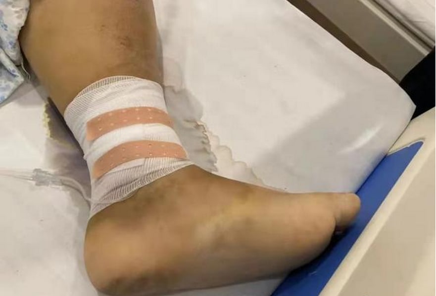 李亚明被送到医院全身浮肿，抽不出来血