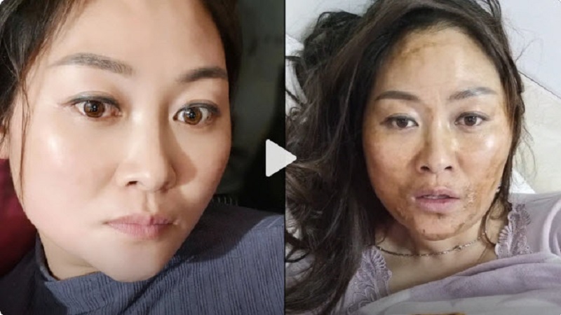染疫4天， 安徽女上吐下泻瘦8斤， 满脸黑糊糊的像毁容。