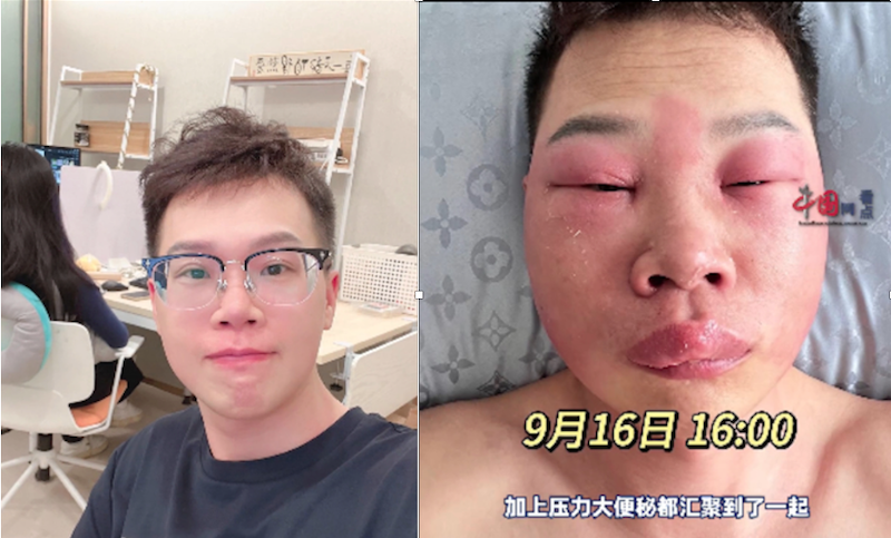 北京男感染丹毒面部红肿变形