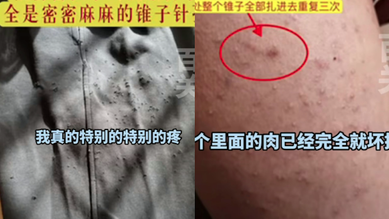 济南女生称被同桌扎218针